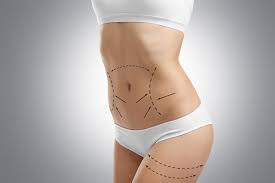 Important Aspects to Weigh Before Undergoing Liposuction in Dubai