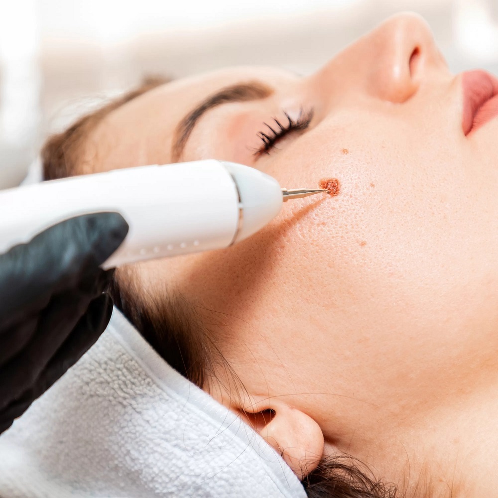 Get Rid of Unwanted Moles with Glamorous Clinic in Islamabad