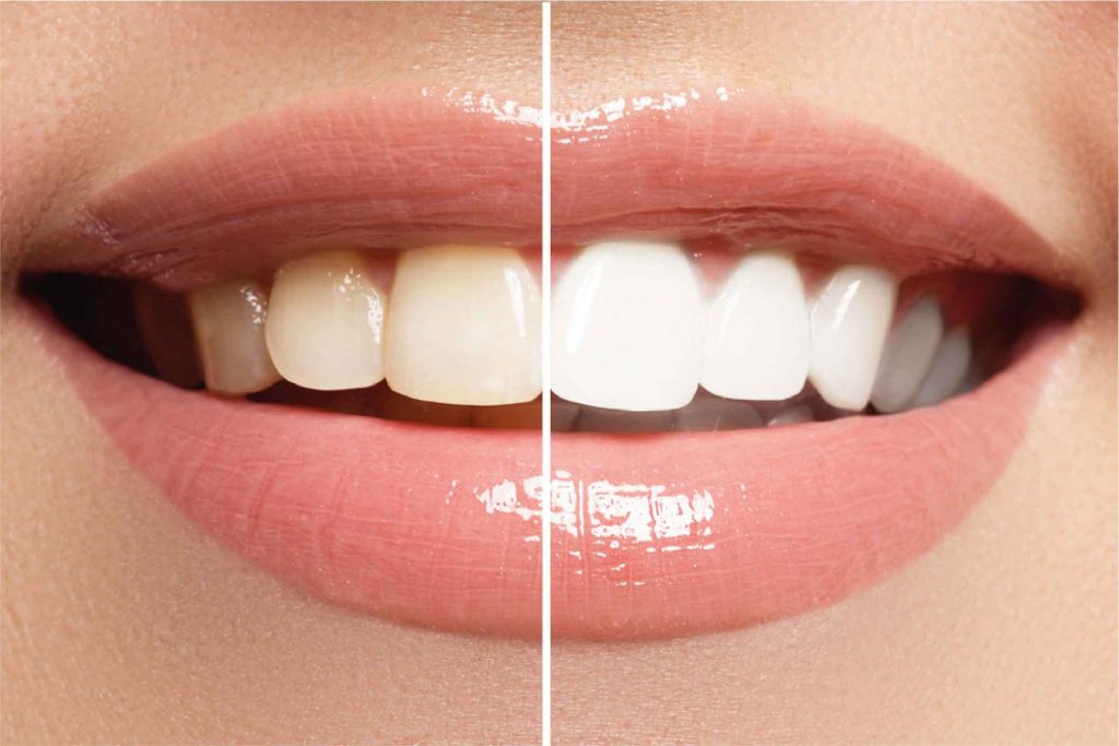 The Best Teeth Whitening Solutions for a Radiant Smile