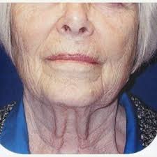 Best 7 Brow Lift Surgery San Diego