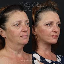 Best 10 Face Lift Providers in San Diego