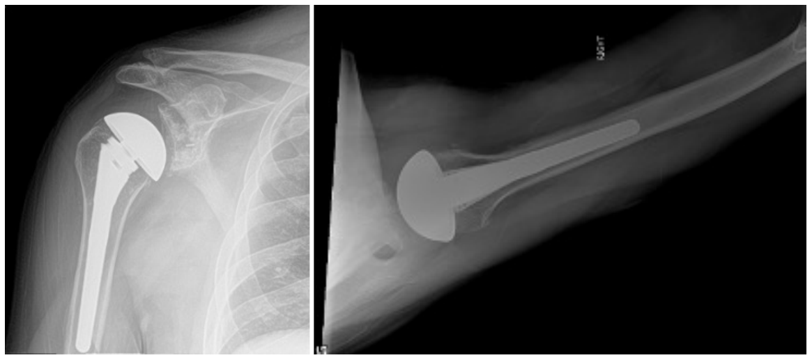 Shoulder Arthroplasty Market Size, Share, Growth, Challenges and Global Forecast 2025-2033