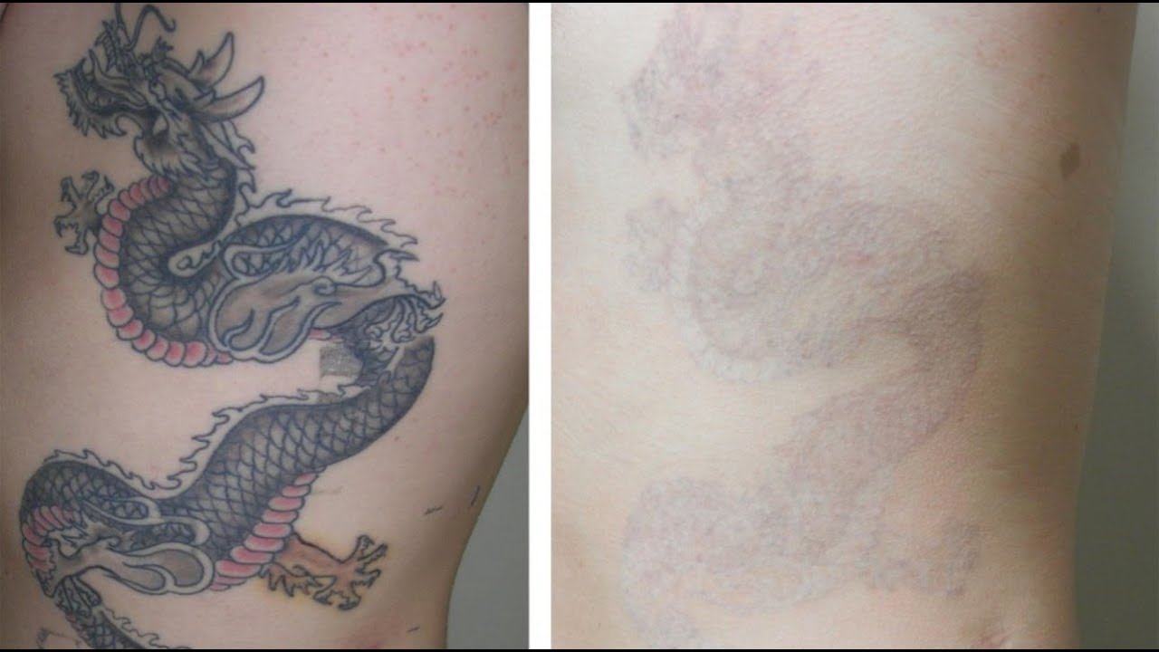 What Types of Tattoos Are Easiest to Fade?