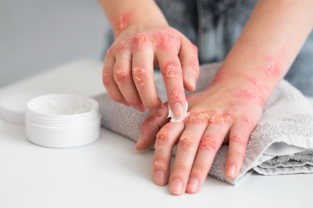 What are the Effective Treatments for TSW and Eczema?