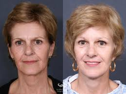 Best 8 Facelift Surgeons in San Diego’s
