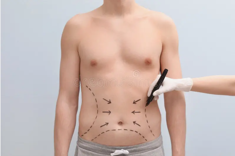Riyadh’s Most Trusted VASER Liposuction Centers