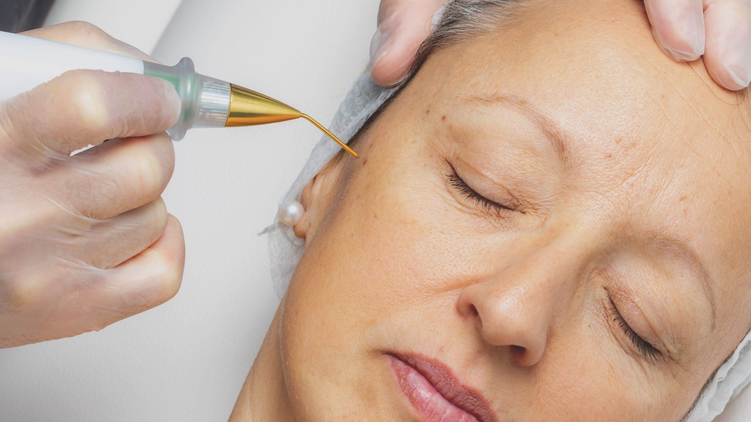 How Does Cryotherapy Compare to Laser for Skin Tag Removal?