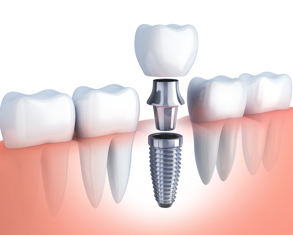 Transform Your Teeth in Just One Day with Same-Day Implants