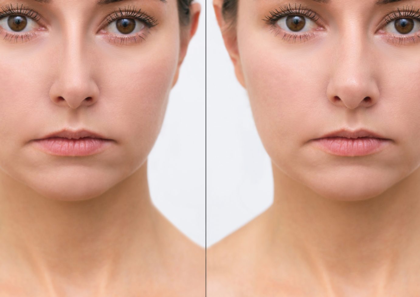 Is Rhinoplasty the Best Procedure for Your Ideal Nose?