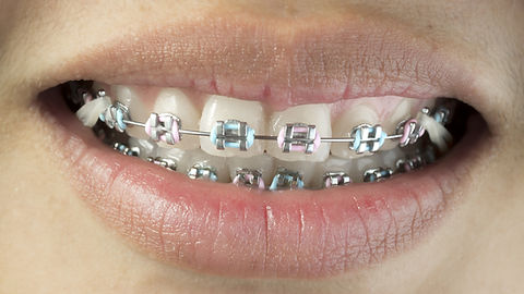 Teeth Braces in Dubai: What Influences the Cost and How to Save