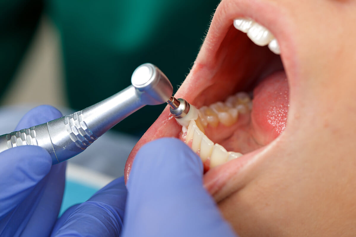Why Gum Contouring is a Game-Changer for Your Smile