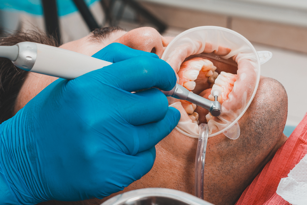 Full Mouth Rehabilitation: The Key to a Stunning Smile Makeover