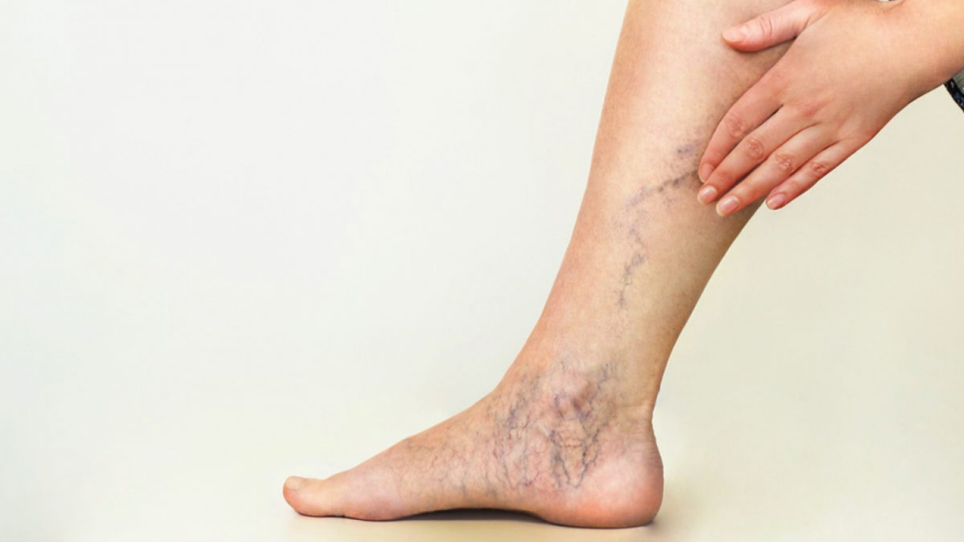 What vitamin deficiency causes spider veins?