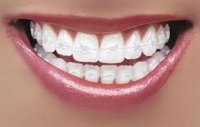 Choosing the Right Dental Braces for Your Lifestyle
