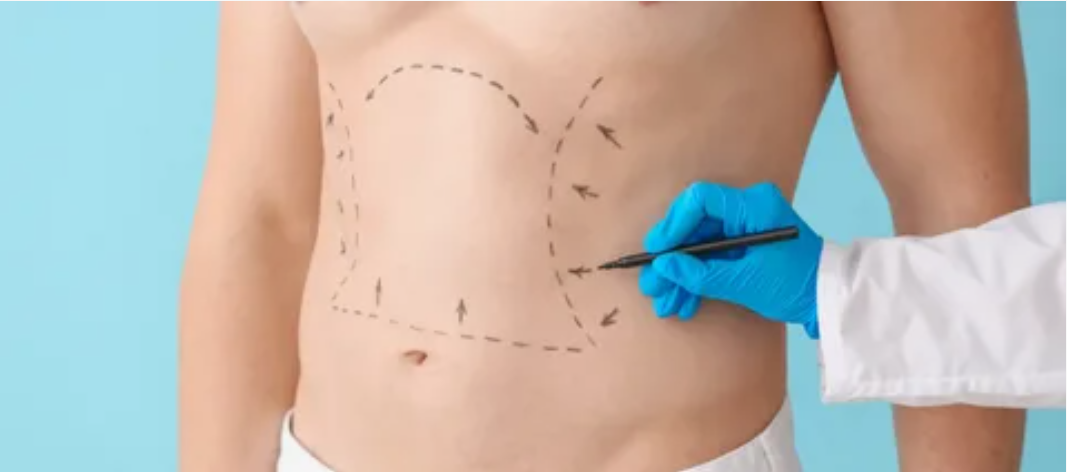 Liposuction vs. Tummy Tuck: Which Is Right for You in Riyadh?