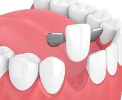 Exploring Modern Alternatives to Partial Dentures in Timonium
