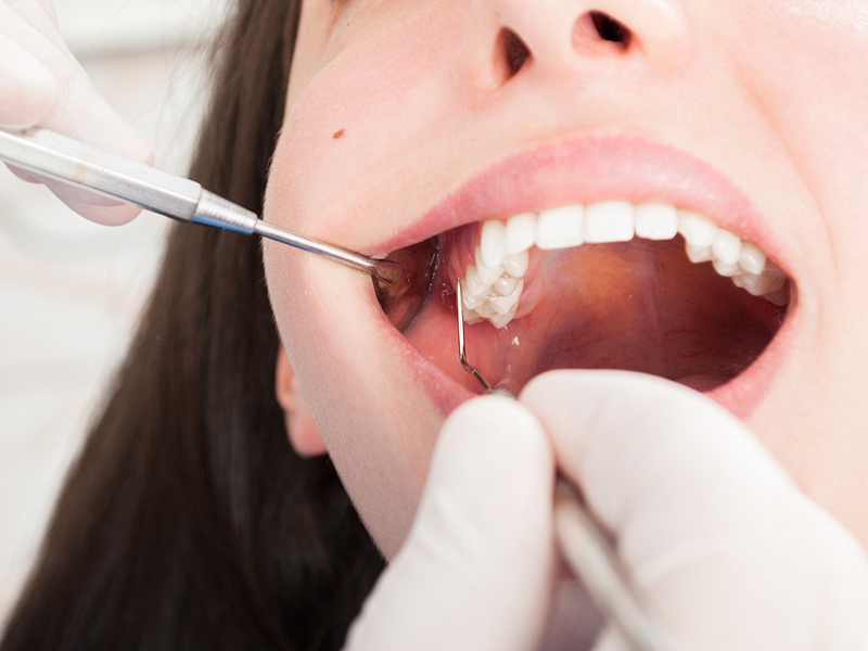 Achieve the Perfect Gum Contour with Gingivectomy Treatment