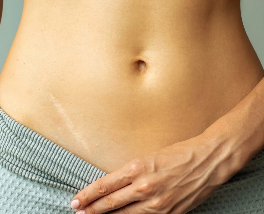 Reclaim Your Confidence with Scar-Free Skin at Glamorous Clinic