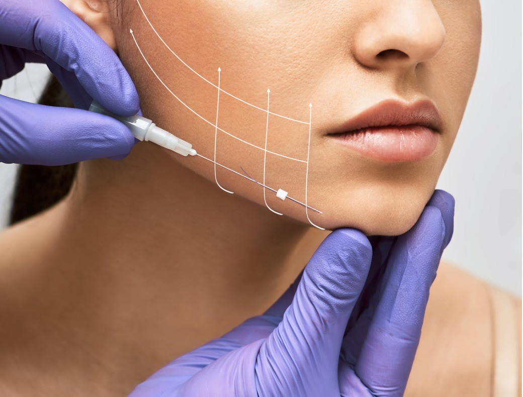What Benefits Can a Thread Lift Offer?