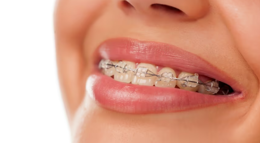 Caring for Your Braces: Tips from the Best Orthodontists in Abu Dhabi