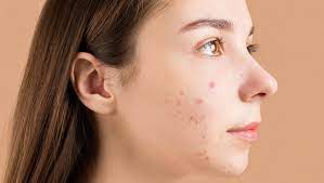What Precautions Should Be Taken After Acne Treatments in Dubai?