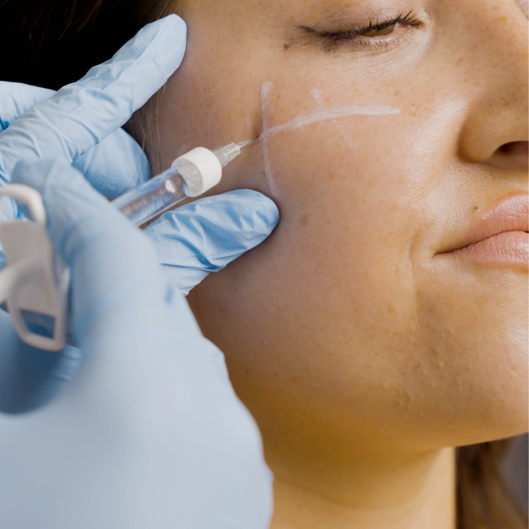 Radiesse for Cheek Augmentation: A Trend in Muscat’s Beauty Scene