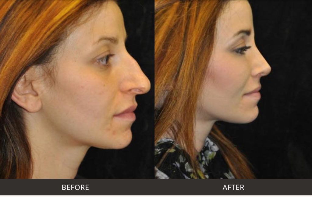 Finding the Best Rhinoplasty Surgeon in California: Specialist’s Tips on How to Get the Best of Both Worlds