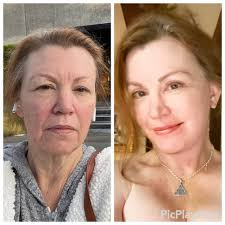 Top 9 Neck Lift in San Diego