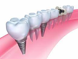 Get Your Perfect Smile Today with Same-Day Implants