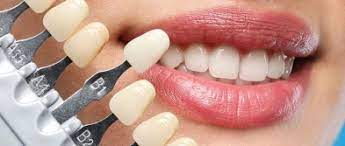 How Dental Veneers Can Fix Discolored, Chipped, and Crooked Teeth