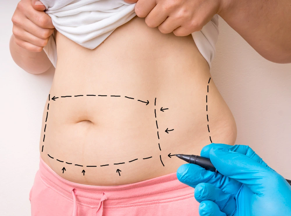 Sculpting Perfection Tummy Tuck Benefits You Need to Know