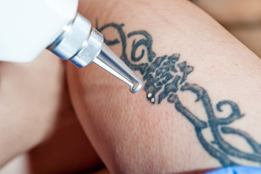 How Do Tattoo Removal and Fading Services Work Together?