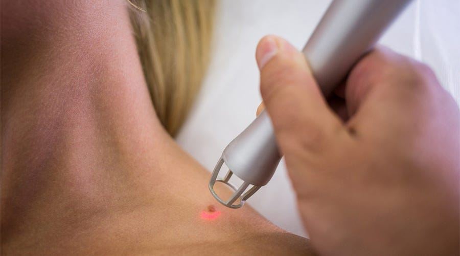 Is Skin Tag Removal the Right Treatment for Your Skin?