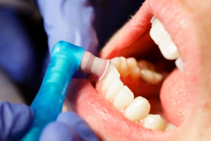 Polishing Your Smile: The Role of Scaling in Dental Hygiene