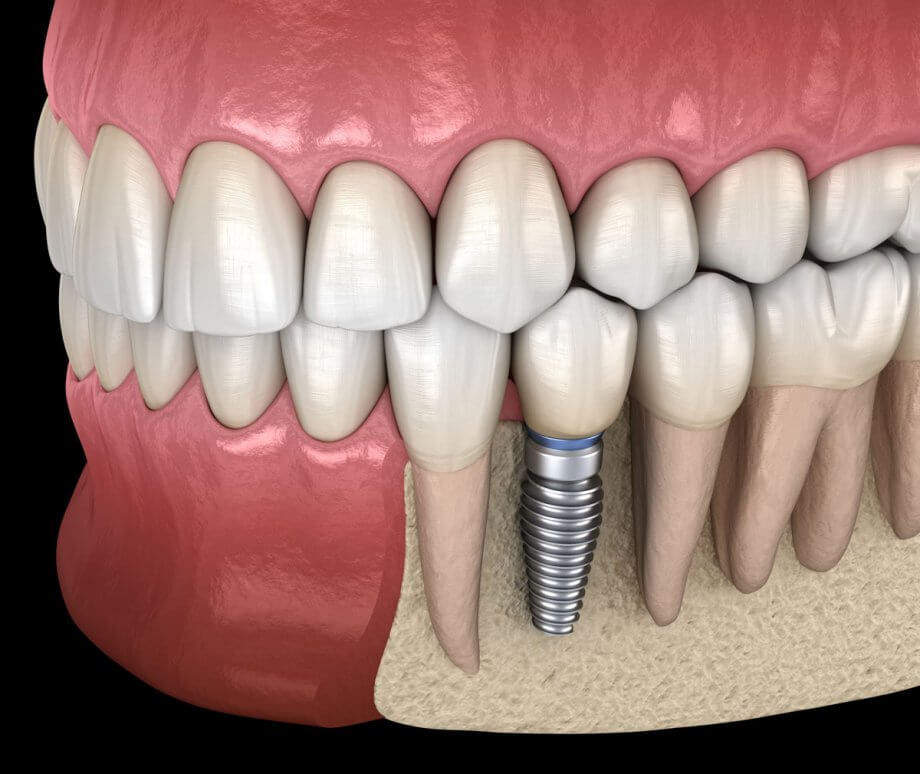 The Psychological Benefits of Dental Implants: How They Improve Self-Esteem