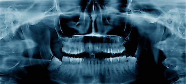 Benefits of Dental Panoramic X-Ray for Accurate Diagnosis