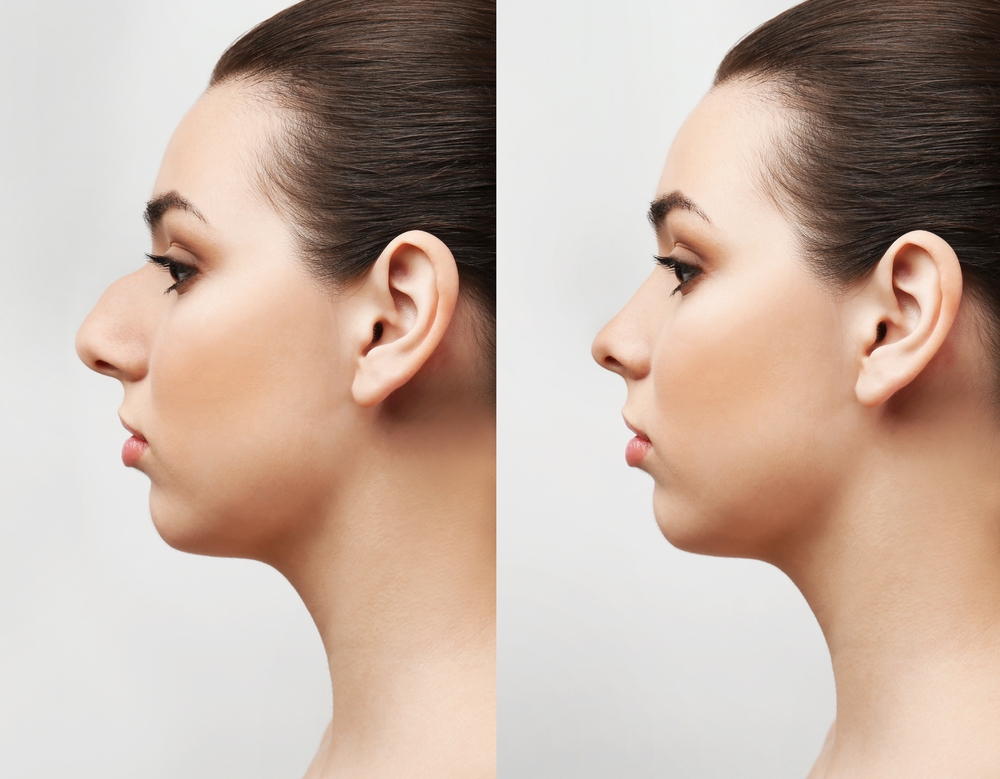 How Rhinoplasty Creates a Perfectly Proportioned Nose
