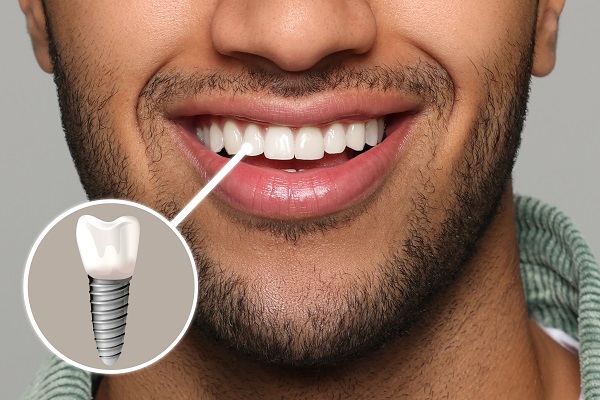 Is It Worth the Investment? Dental Implant Costs in Dubai Explained