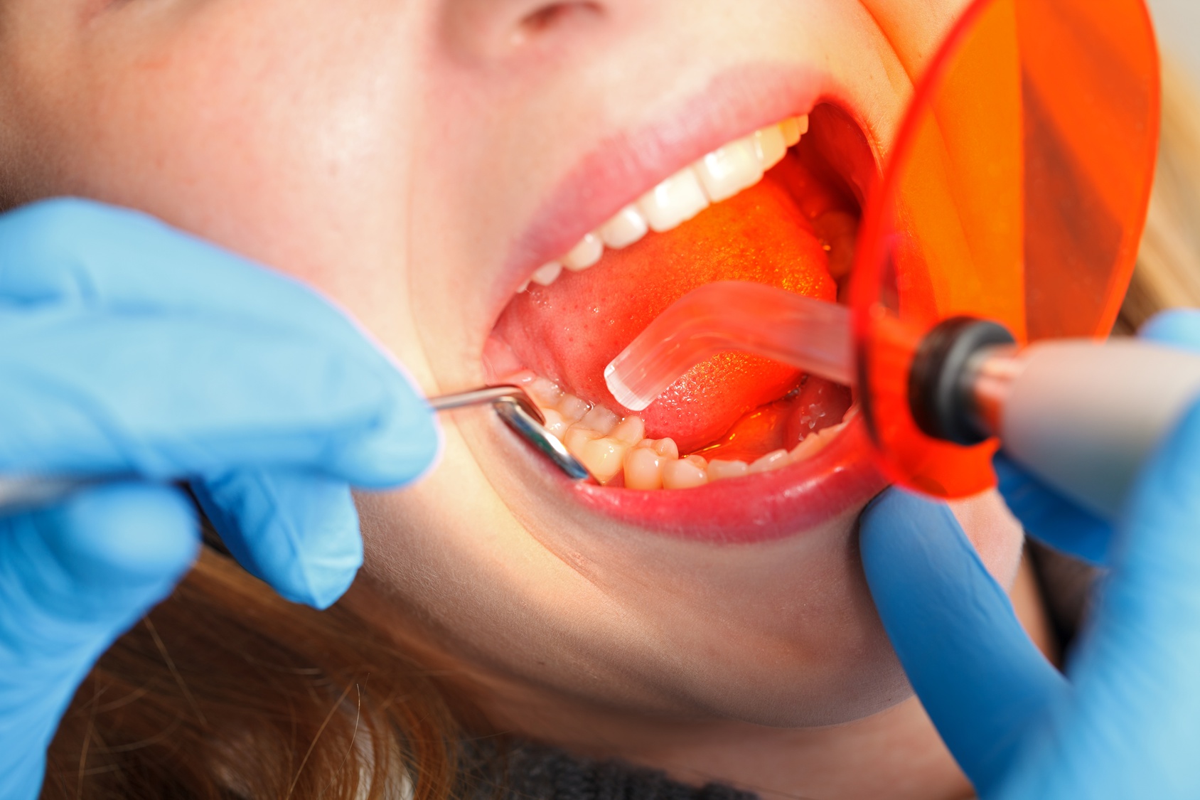 Common Myths About Tooth Fillings Debunked