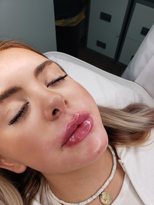 The Best Russian Lip Filler Specialists in Dubai – Transform Your Look