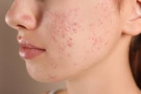 Breaking New Ground in Acne Treatment: Spotlight on the Top 5 Players