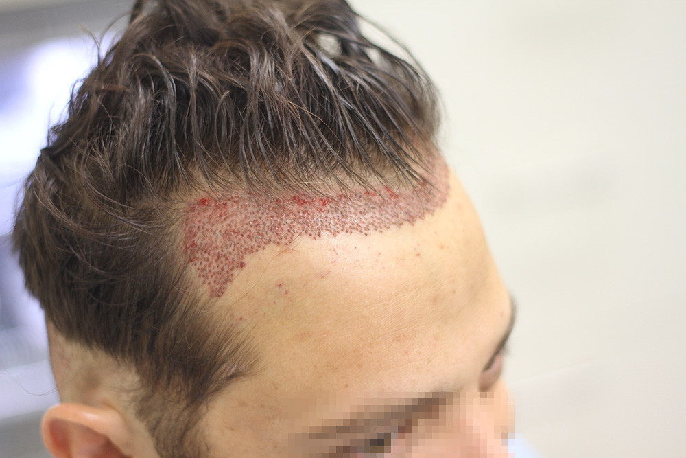 Hair Transplant Packages in Dubai: Are They Worth It?