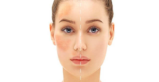 Melasma Treatment What You Need to Know for Better Results