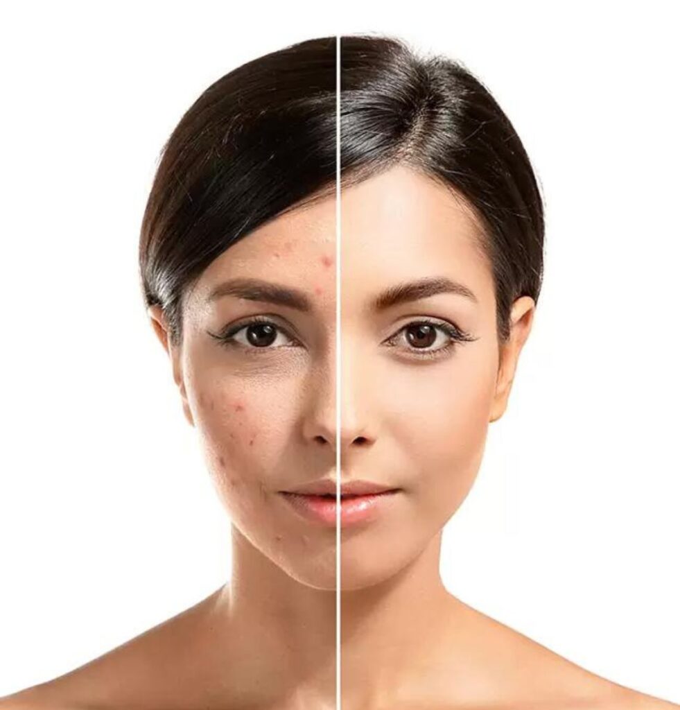 Are Acne Scar Treatments in Dubai Safe Here’s What You Need to Know