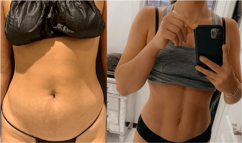 Liposuction in New York City: Sculpting Your Ideal Contours