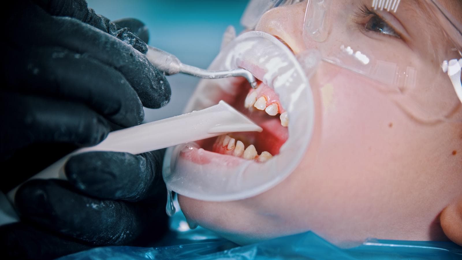 Hidden Fees in Tooth Extraction: What to Watch Out For