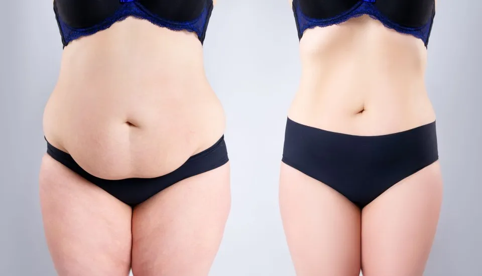 Your Step-by-Step Guide to Gastric Balloon Treatment in Dubai