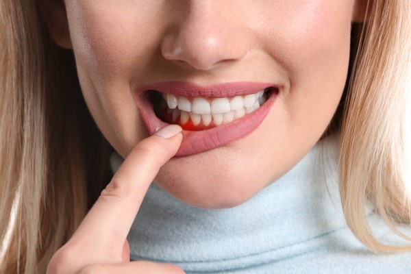 The Emotional Impact of Gum Contouring: Smiling With Confidence Again