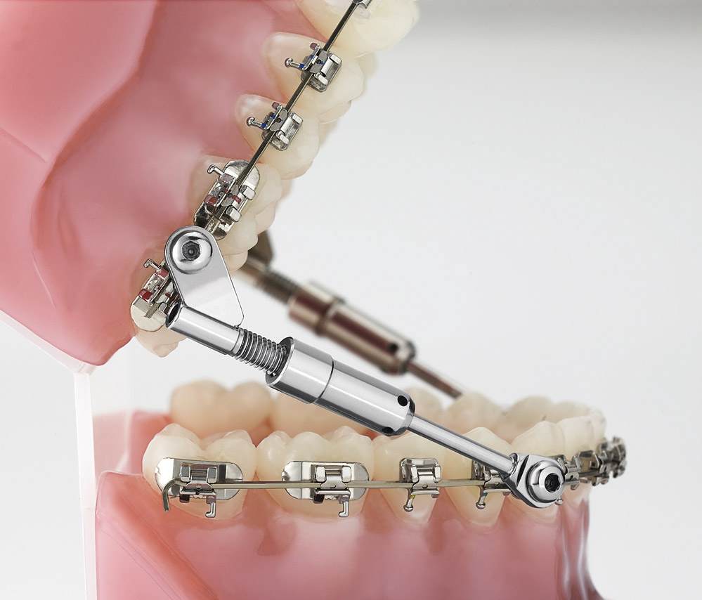 Choosing the Right Dental Appliance for Your Needs