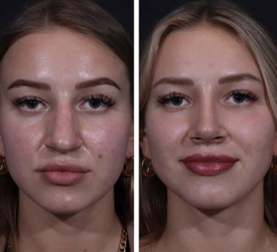Discovering the Best Rhinoplasty Near Me: A Comprehensive Guide